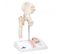 Модель перелома бедренной кости и остеоартрита тазобедренного сустава