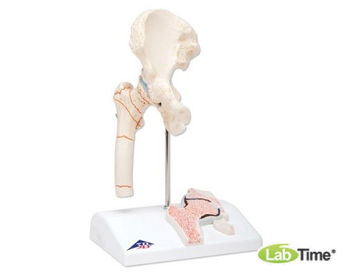 Модель перелома бедренной кости и остеоартрита тазобедренного сустава