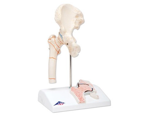 Модель перелому стегнової кістки і остеоартриту тазостегнового суглоба