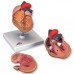 Классическая модель сердца с гипертрофией левого желудочка, 2 части