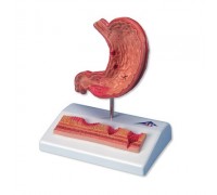 Модель шлунка з виразками, 2 частини